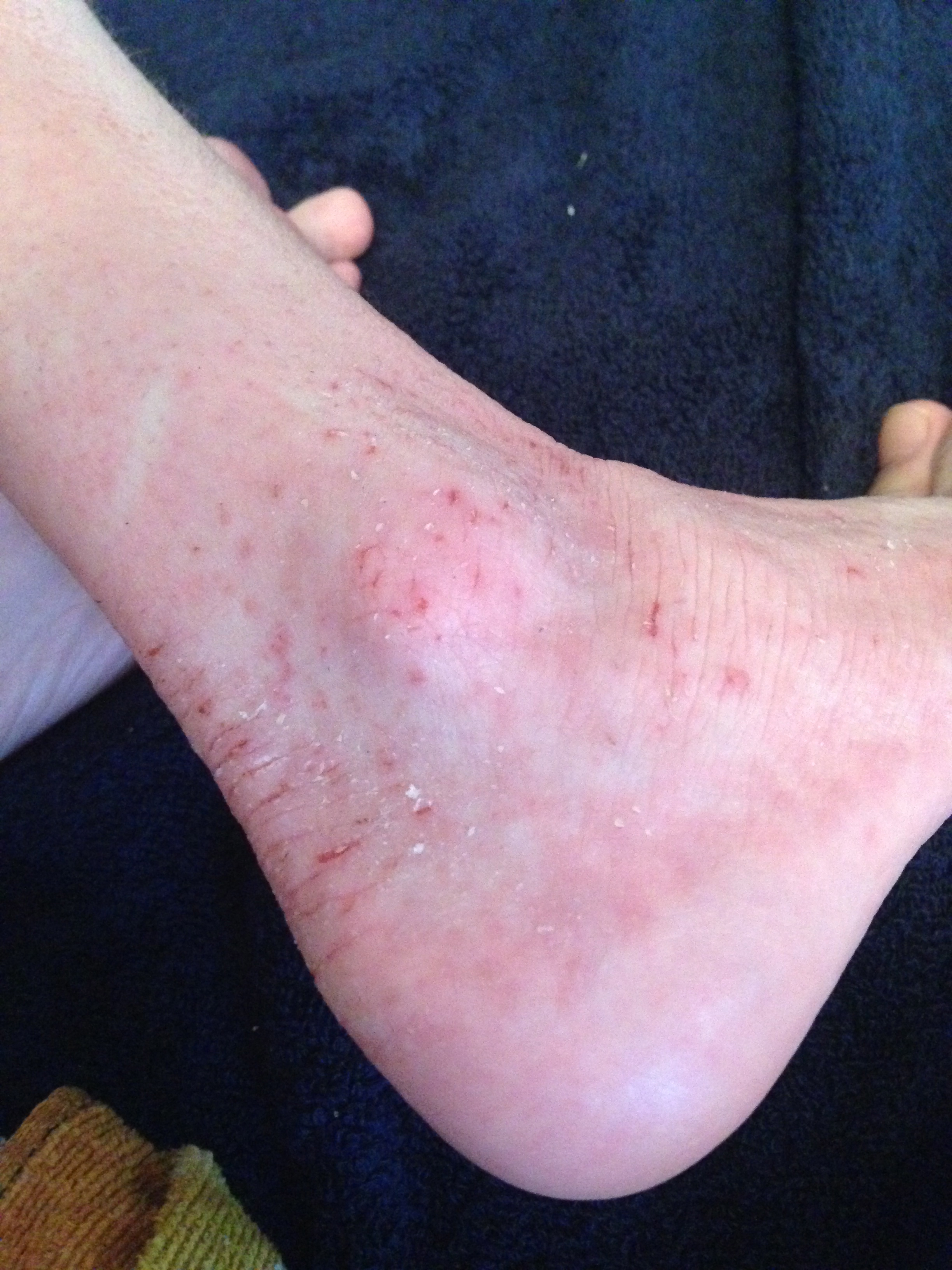 Dry Patch Of Skin On Ankle