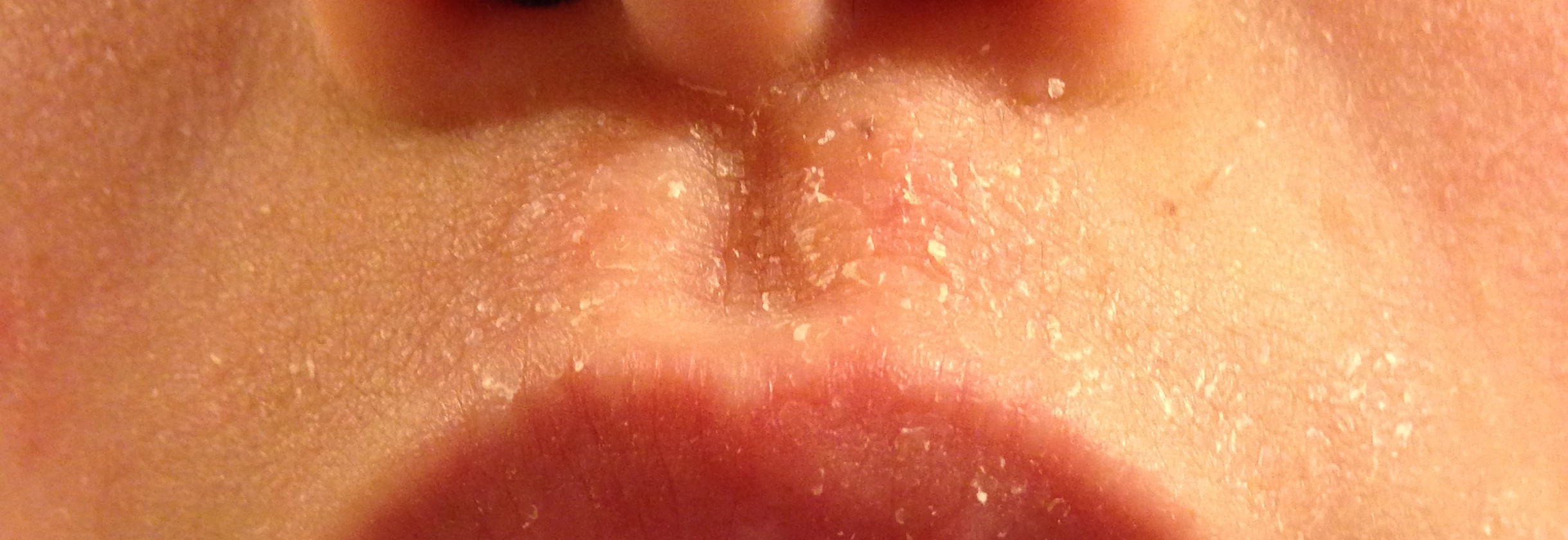 Raised Small Red Bumps around Eyes - MedHelp